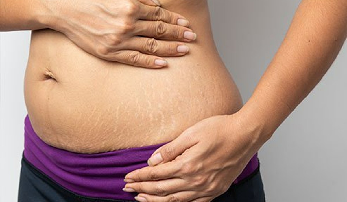 different ways to solve stretch marks problem on body