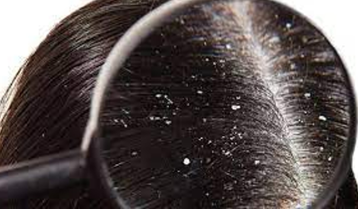 health tips to solve dandruff problems